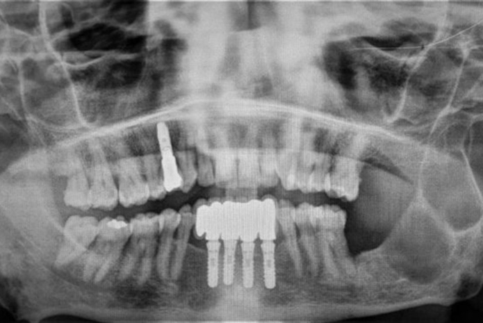 Queratoquiste odontogénico gigante