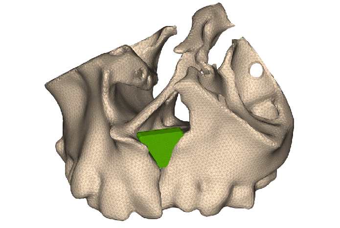 implante bioinspirado para la regeneración ósea en niños con fisura labiopalatina