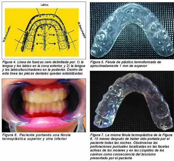 La Contencion Natural Como Solucion A La Recidiva Ortodoncica Gaceta Dental