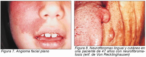 Lesiones Tumorales Y Pseudotumorales Benignas De La Cavidad Oral