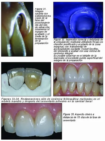 Preparacion Protesica Con La Tecnica Del Chamfer Modificado Y La Utilizacion De Instrumental No Rotatorio Sonico Gaceta Dental